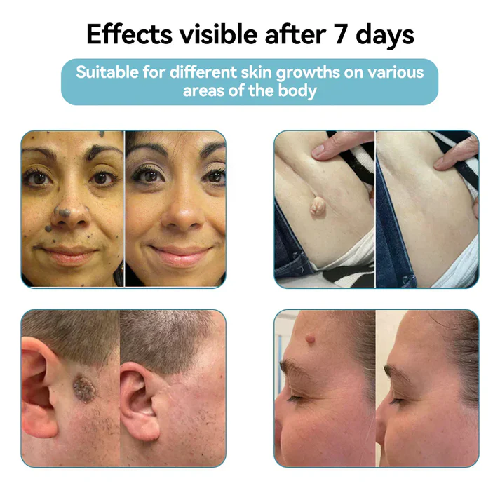 🌎Ends Today: 70% OFF!🔥Tiworld™ All-in-One CO₂ Laser Eraser Pen | USB Rechargeable | Removes Moles, Warts, Skin Flaws & Pigmentation
