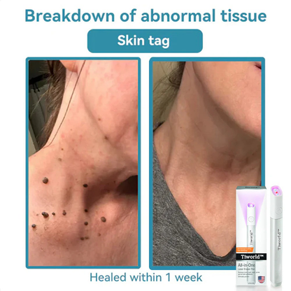 🌎Ends Today: 70% OFF!🔥Tiworld™ All-in-One CO₂ Laser Eraser Pen | USB Rechargeable | Removes Moles, Warts, Skin Flaws & Pigmentation