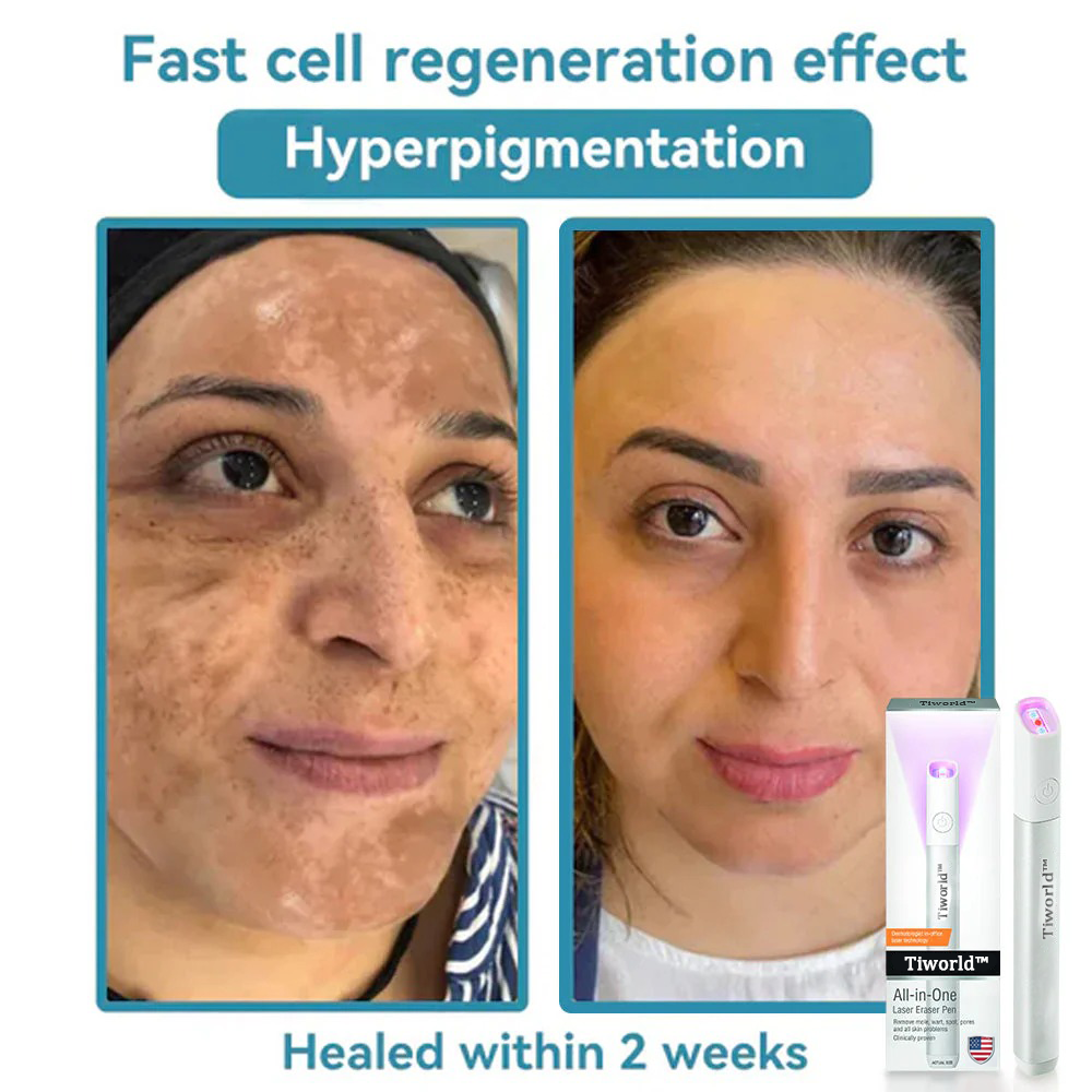 🌎Ends Today: 70% OFF!🔥Tiworld™ All-in-One CO₂ Laser Eraser Pen | USB Rechargeable | Removes Moles, Warts, Skin Flaws & Pigmentation