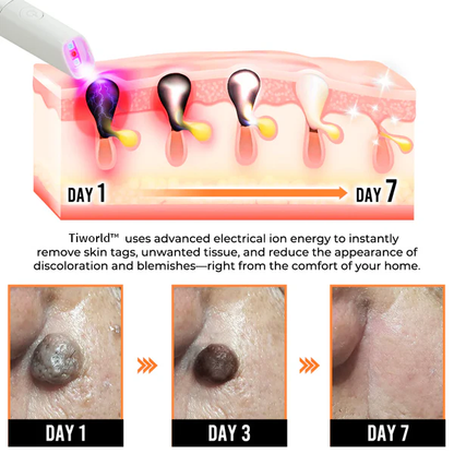 🌎Ends Today: 70% OFF!🔥Tiworld™ All-in-One CO₂ Laser Eraser Pen | USB Rechargeable | Removes Moles, Warts, Skin Flaws & Pigmentation